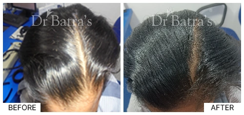 Hair Falling Treatment